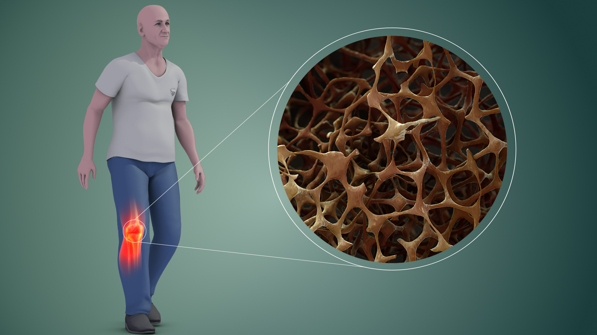 Osteoporosis in bones